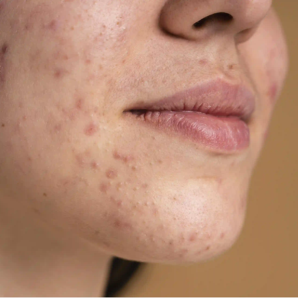 البشرة المعرضة لحب الشباب