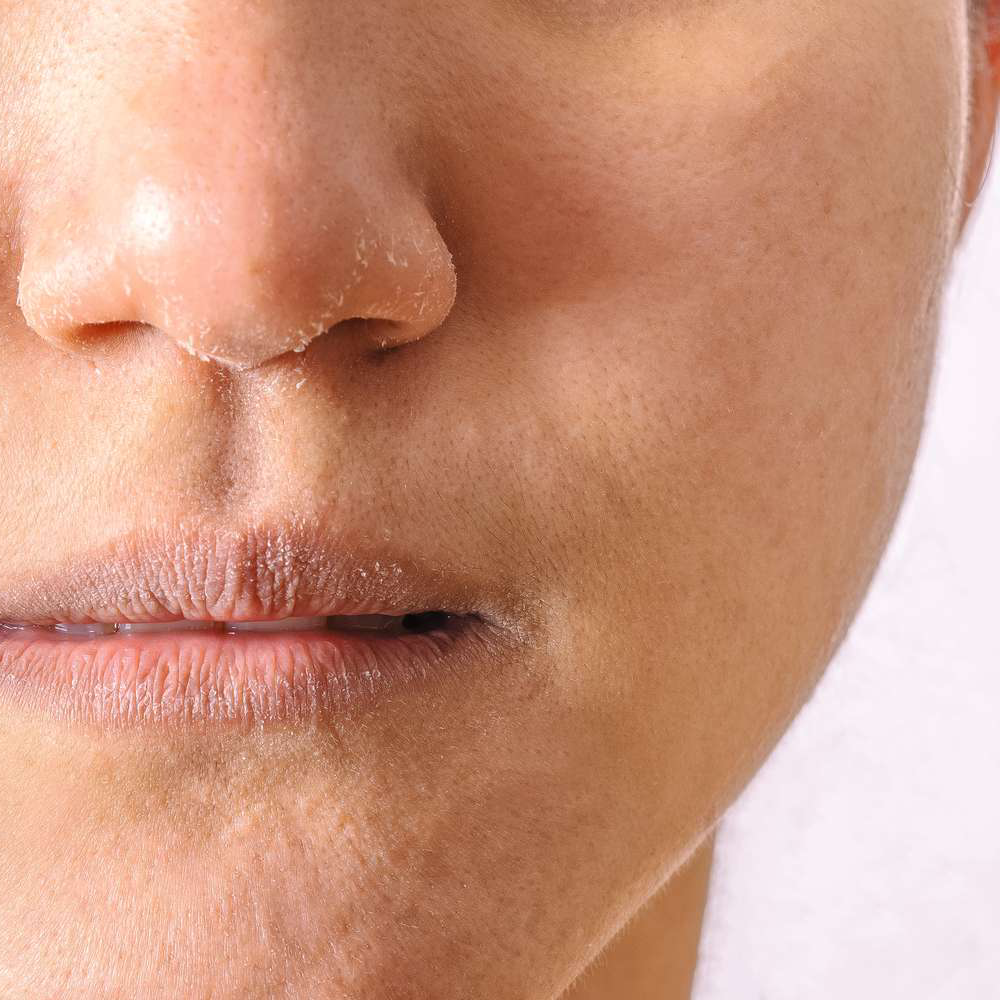 البشرة الجافة