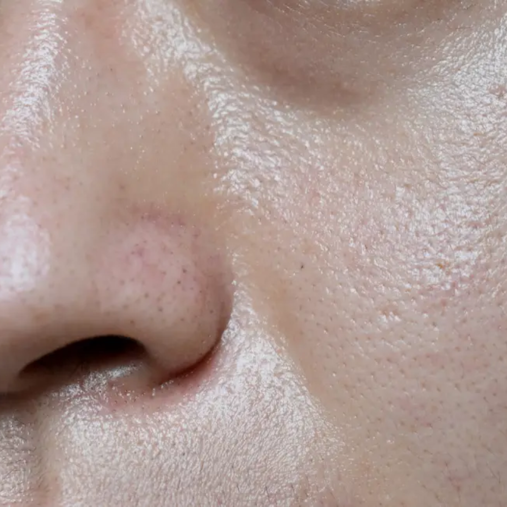 البشرة الدهنية