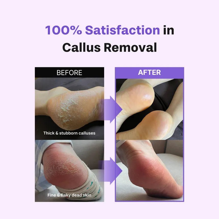 Baren - Foot Callus Eraser Home Set | مجموعة إزالة وتنعيم الكالو والجلد الميت من القدمين في المنزل - الصورة 7